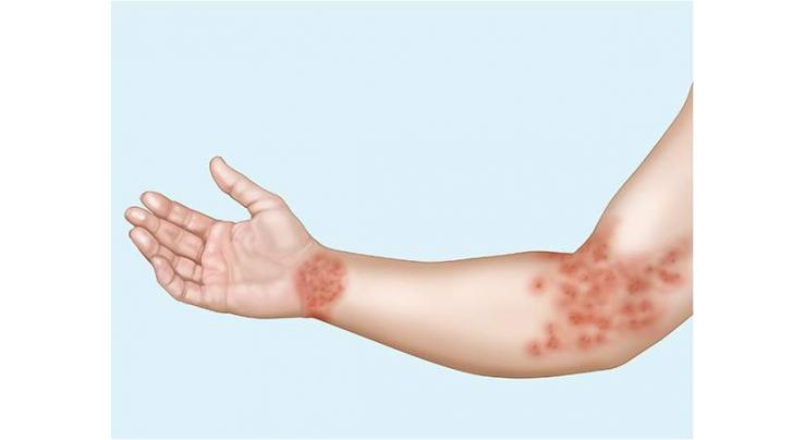 Eczema can be managed with proper treatment, avoidance of triggers: 
