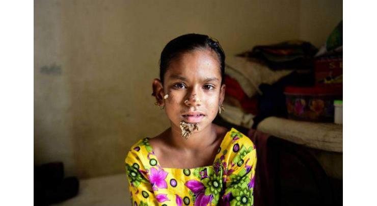 Bangladesh treats first case of 'tree girl' syndrome 