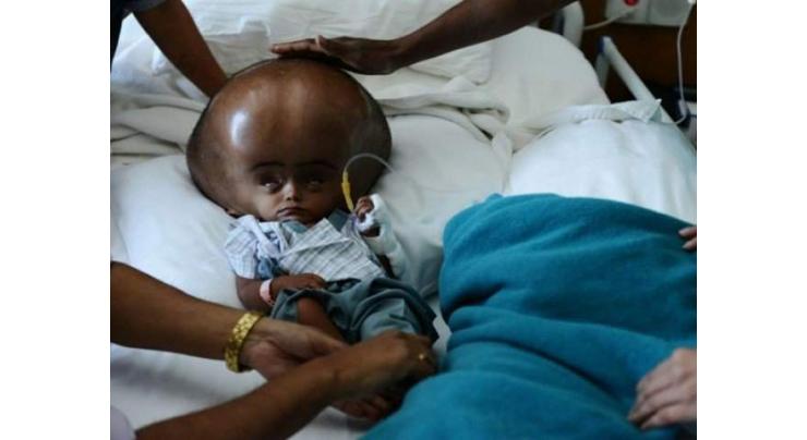 Indian girl with rare condition dies suddenly 