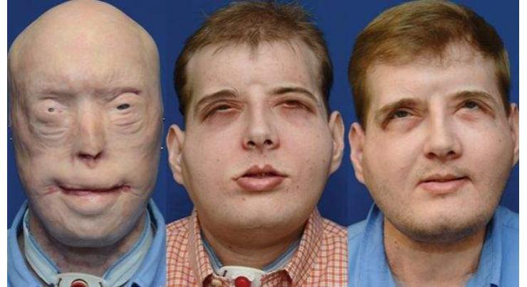 Second face transplant for Frenchman in world-first 