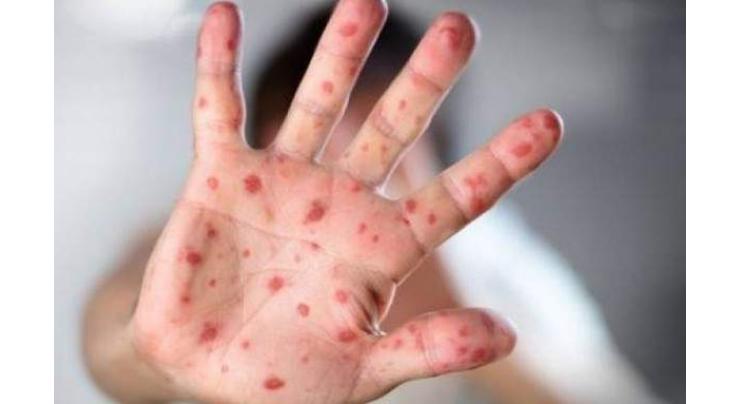 Venezuela urged to stop spread of measles, diphtheria
