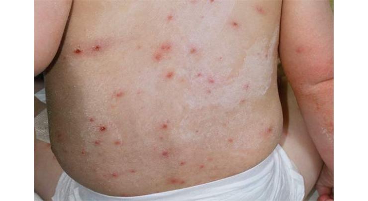 Chickenpox disease mainly affects children below 12 years: Pediatrician
