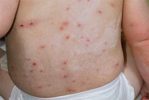 Chickenpox Disease Mainly Affects Children Below 12 Years ...
