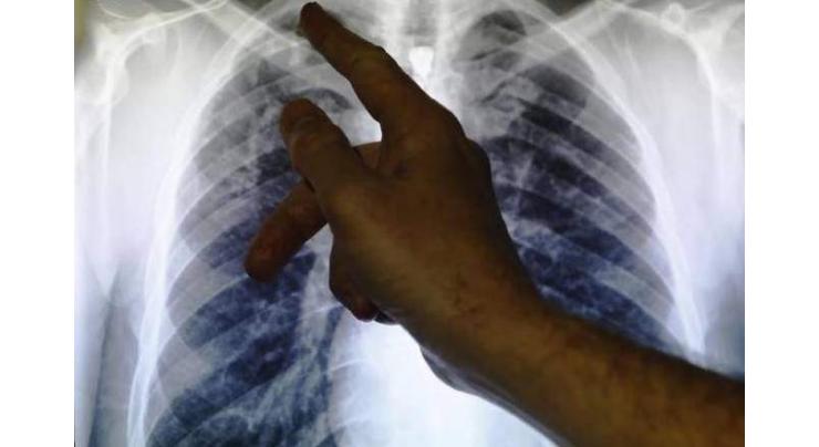'Game changer' tuberculosis drug cures 8 in 10
