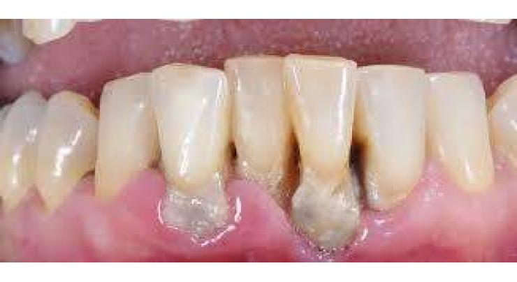 Periodontal disease major reason for losing teeth: dentist
