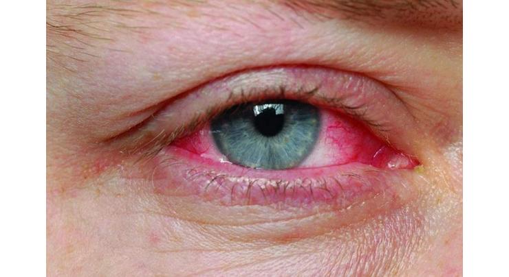 Acontagious infections cause conjunctivitis: Dr.Jamil
