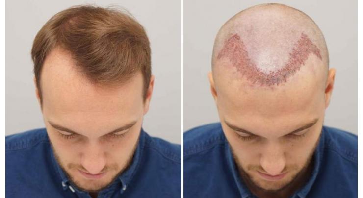 200 foreigners visit monthly for hair transplant

