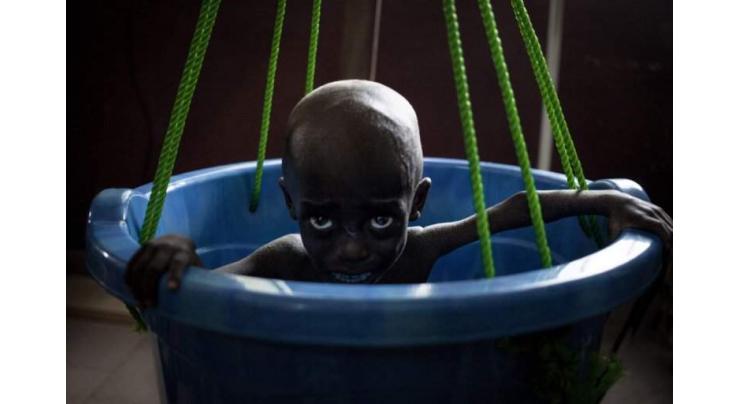 The battle to save Central African Republic's starving children
