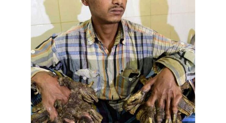Bangladeshi 'Tree Man' dreams of cure as rare skin disease returns
