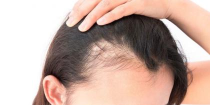 How To Treat Female Hair Loss - UrduPoint