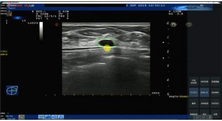 Chinese firm develops Al-powered ultrasound tech for breast screening
