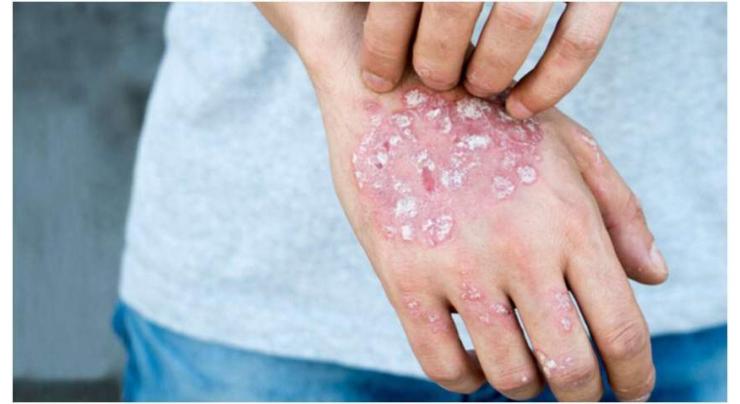 Awareness stressed on 'World Psoriasis day'
