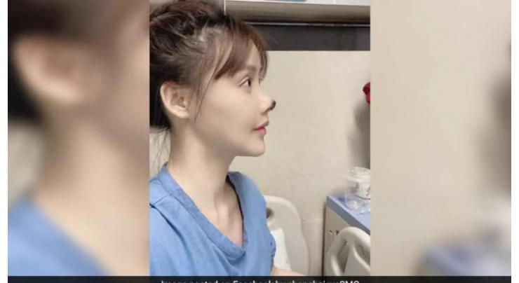 Chinese actress shares photos of her botched nose surgery
