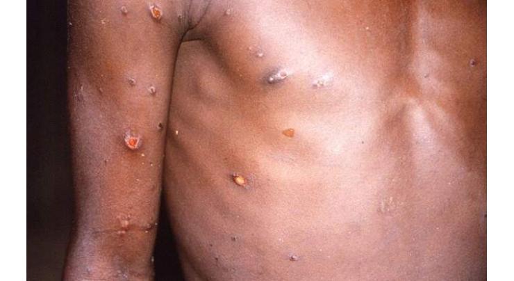 U.S. confirms first monkeypox case in 2022

