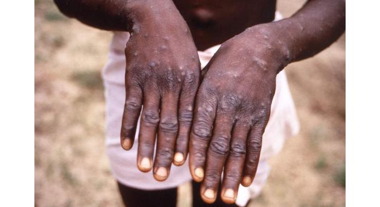Portugal reports 5 confirmed monkeypox cases
