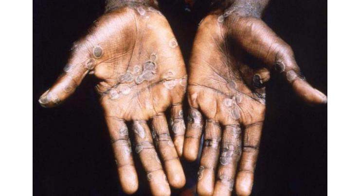 Belgium Detects First Two Monkeypox Cases, France Confirms One Case