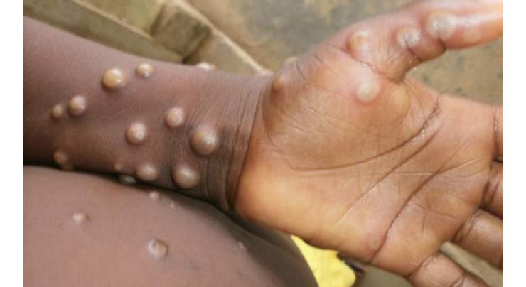 New monkeypox cases take UK total to 20
