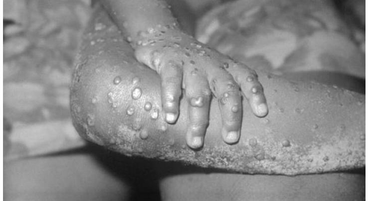 Portugal Confirms 23 Cases of Monkeypox
