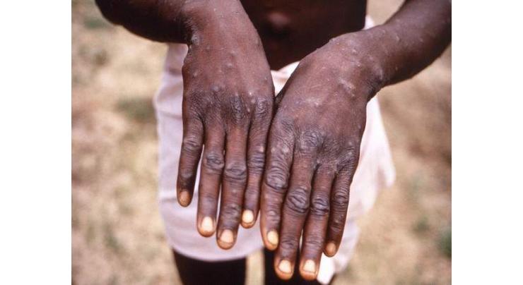 Monkeypox can be stopped outside endemic countries: WHO

