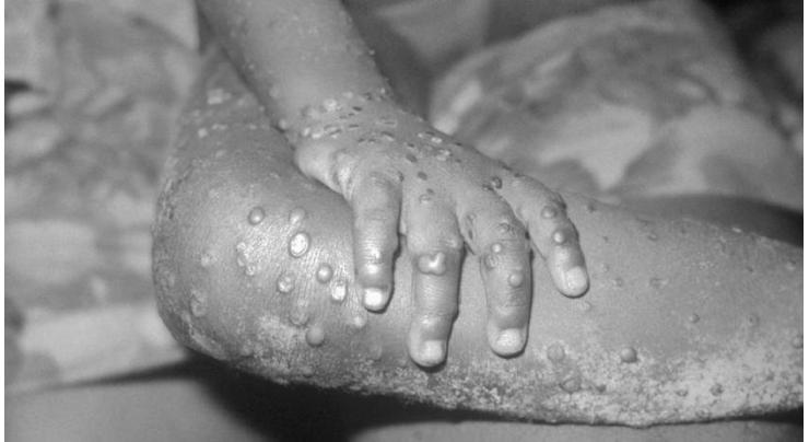 Monkeypox cases rise to 6 in Netherlands
