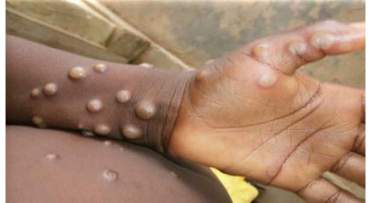 Monkeypox Outbreak Can Still Be Contained, Risk of Transmission Low - WHO