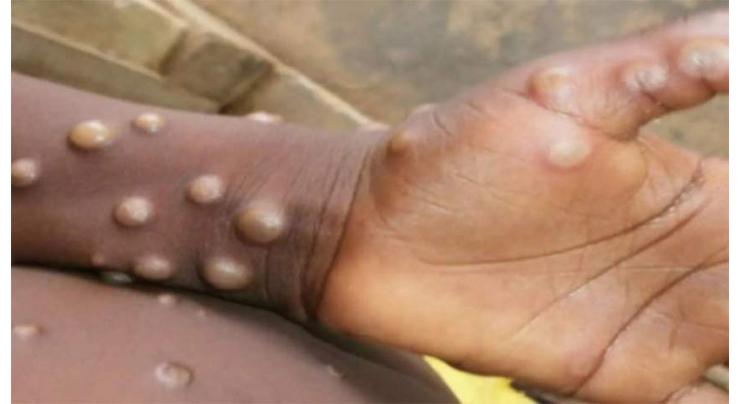 Hospitals asked to ensure readiness for isolated treatment in suspected Monkeypox cases
