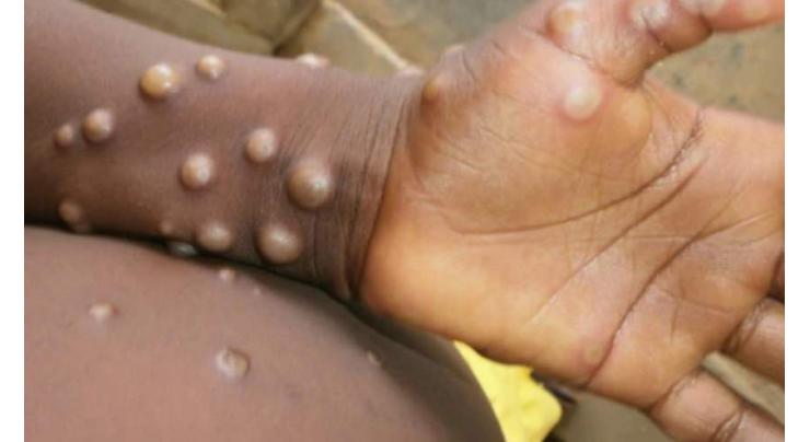 DC appeals citizens to avoid rumors about monkeypox spread in Capital
