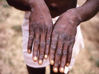 Monkeypox may persist in body for 10 weeks, even after rash fades: Study
