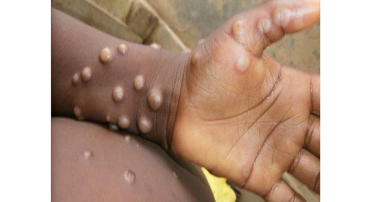 WHO calls for 'urgent' action in Europe over monkeypox
