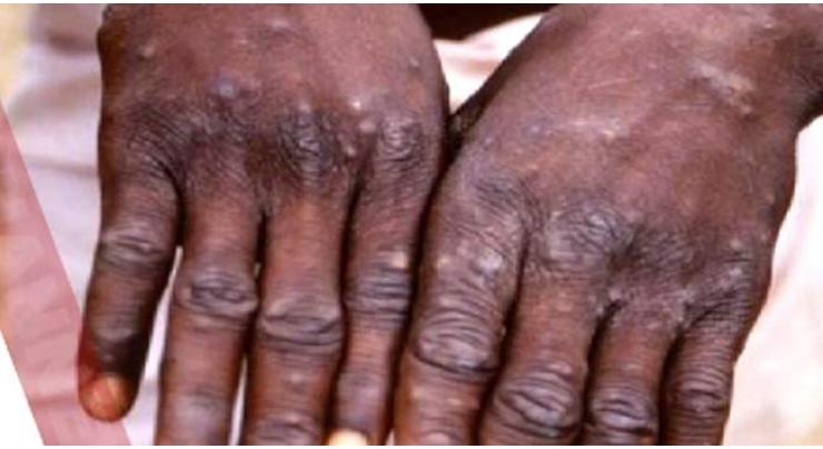 Monkeypox: From beginnings in Africa to global spread
