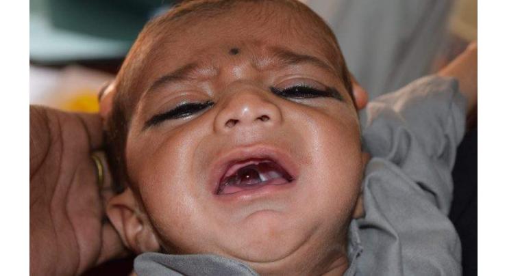 Cleft lip, cleft palate patients to receive free treatment