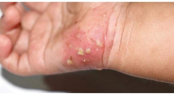 Scabies transmits person to person through close skin contact :Skin specialist
