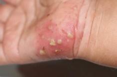 Scabies is transmitted disease: Skin specialist