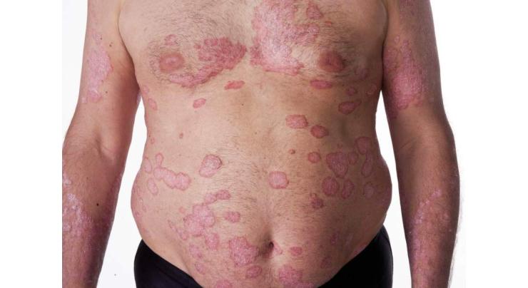 Psoriasis a inflammatory skin disease: Dr. Iqbal