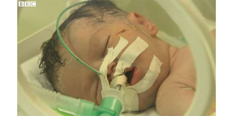 غزہ میں مردہ خاتون کے بطن سے بچی کی پیدائش