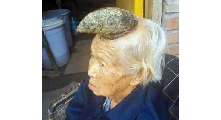 اس بوڑھی خاتون کے سر پر واقعی سینگ اگ آیا ہے