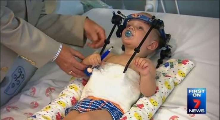 جدید سائنس کا ایک اور معجزہ، آسٹریلیا کے ڈاکٹرز نے حادثے میں تن سے سر جدا ہوجانے والے بچے کے سر کوواپس جوڑدیا