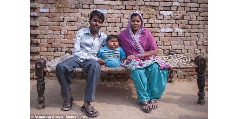 دس ماہ کی بچی کا وزن اس کی زندگی کے لیے خطرہ بن گیا
