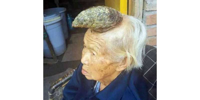 اس بوڑھی خاتون کے سر پر واقعی سینگ اگ آیا ہے