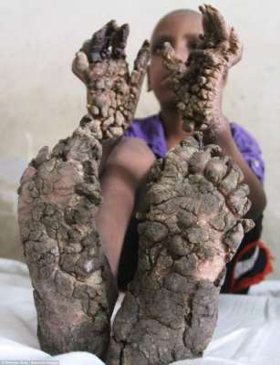 7سالہ بنگلا دیشی بچے کے ہاتھ اور پاؤں  درختوں جیسے ہوگئے