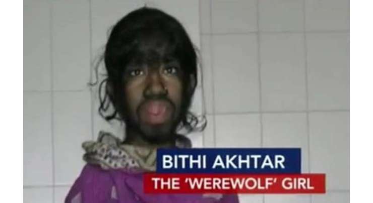 چہر ے اور جسم پر بے تحاشا بالوں اور بڑھے ہوئے جسمانی اعضا نے  12سالہ بنگالی لڑکی کی زندگی اجیرن کر دی