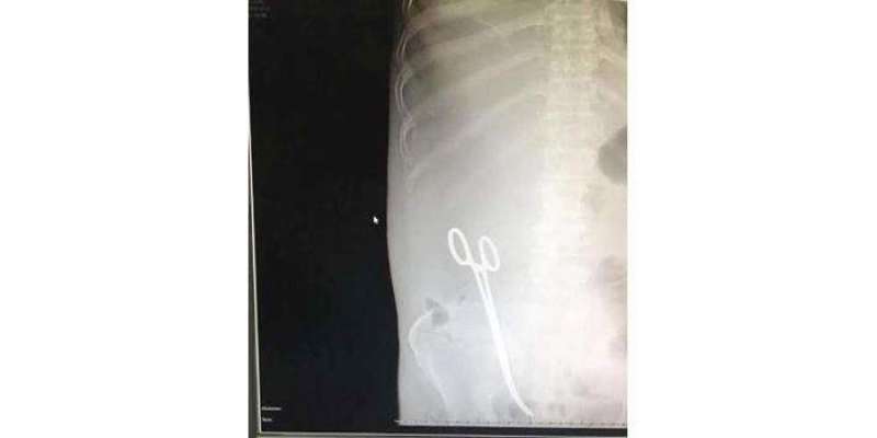 حائل:سعودی ڈاکٹر آپریشن کے دوران مریض کے پیٹ میں قینچی بھول گیا