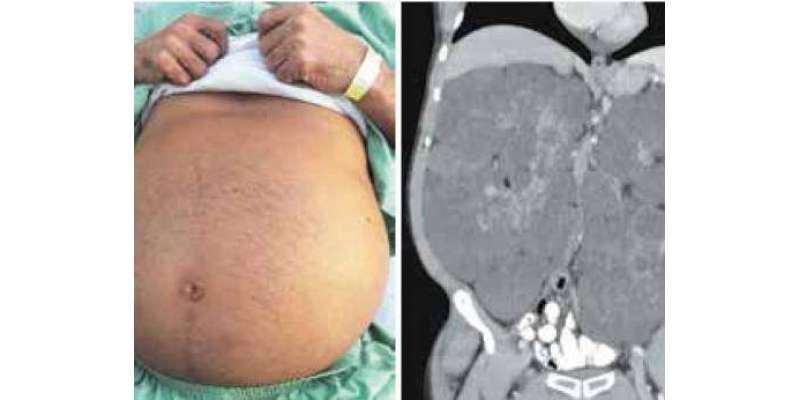 دبئی: ڈاکٹروں نے مریض کے پیٹ سے 13کلووزنی رسولی نکال لی