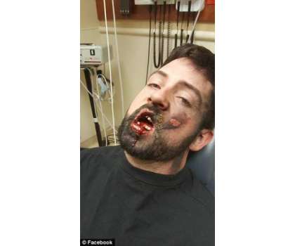 ای سگریٹ منہ میں پھٹنے سے ایک شخص کے 7 دانت ٹوٹ گئے