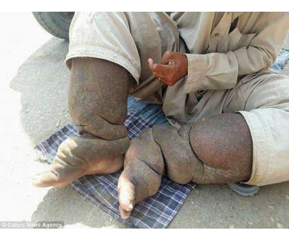 ٹانگیں پھول کر غبارہ ہو گئیں،جلد کی پر اسرار بیماری میں مبتلا کراچی ..