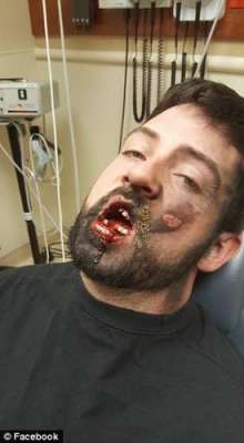 ای سگریٹ منہ میں پھٹنے سے ایک شخص کے 7 دانت ٹوٹ گئے