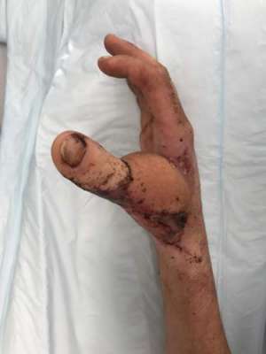 آسٹریلیوی نوجوان کے ہاتھ کا انگوٹھا کٹنے پر ڈاکٹروں نے پاؤں کا انگوٹھا ..
