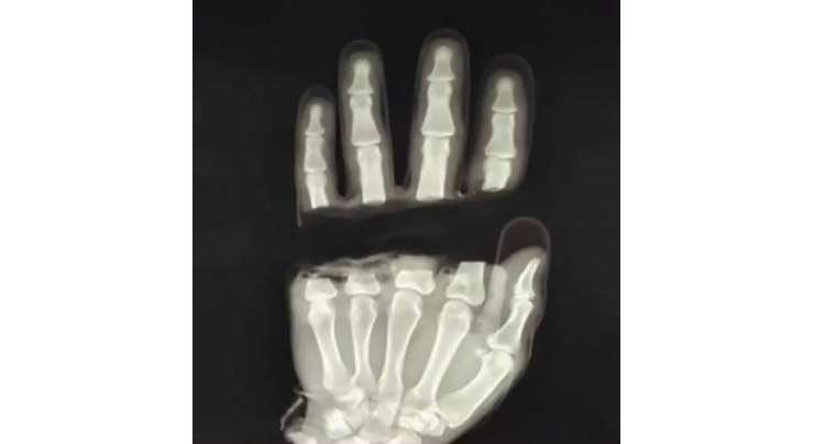 ڈاکٹروں نے11گھنٹے کے آپریشن  سے  حادثے میں ساری انگلیاں کٹوانے والے شخص کی ساری انگلیاں واپس لگا دی