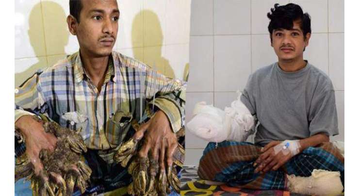 بنگلادیشی ٹری  مین  کا ہاتھ 16 آپریشن کے بعد ٹھیک ہونے کی امید