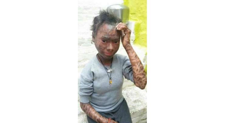 سانپ لڑکی کے نام سے مشہور، عجیب وغریب بیماری کا شکار لڑکی کی جلد ہر دو ماہ بعد اترجاتی ہے